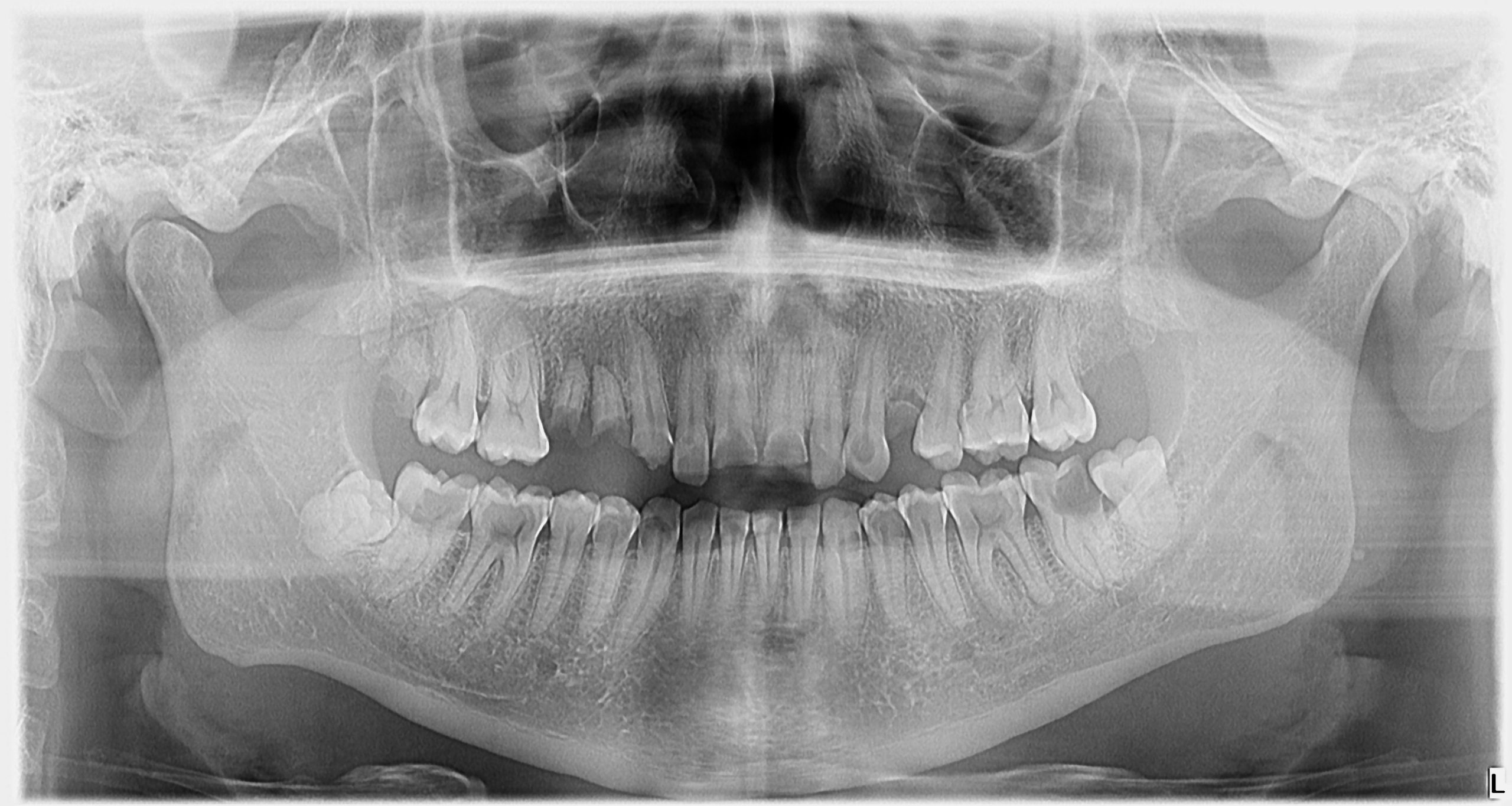 radiografie panoramica facuta inainte sa merg la dentist